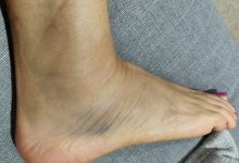 What is the physio for sprained ankle – Know All Important Points?