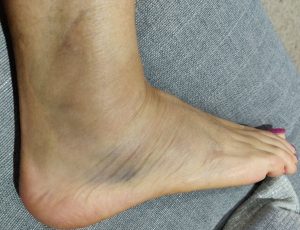 What is the physio for sprained ankle – Know All Important Points?