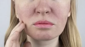 large pores