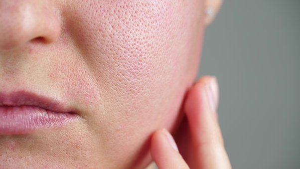 treatment for enlarged pores