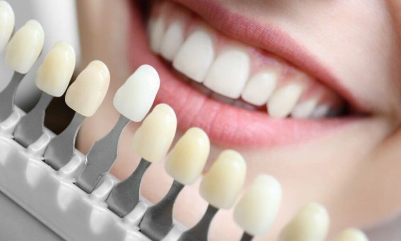 teeth to change colour